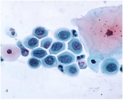 lesions Cervical cytology used to grade severity of