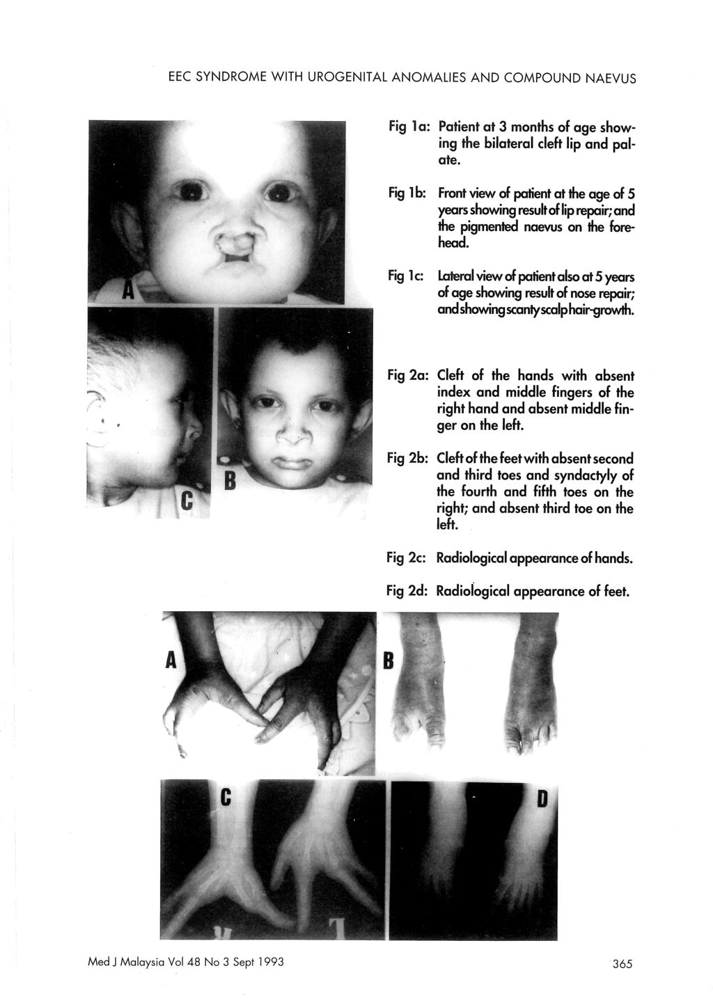 EEC SYNDROME WITH UROGENITAL ANOMALIES AND COMPOUND NAEVUS Fig 1a: Patient at 3 months of age showing the bilateral cleft lip and palate.