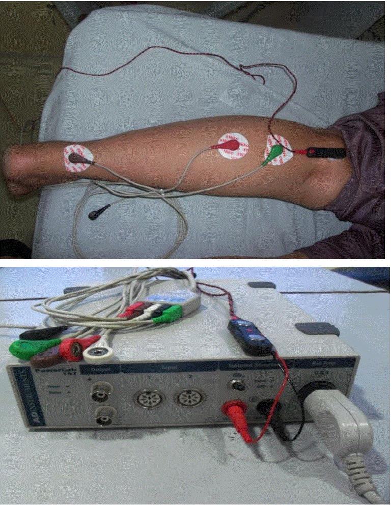 Mobilization for the Treatment of Lumbar Disc Herniation: A Randomized Clinical Trial. 6: 304. doi: 10.4172/2165- Page 4 of 9 Figure 2: Placement of electrodes and stimulator for H reflex testing.