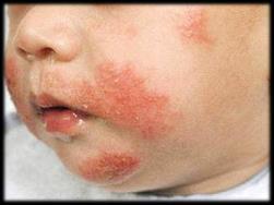 Atopic Dermatitis (Allergic Eczema) 40% of children with AD (before 3 yr