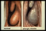 unilateral Anatomical: adenoiditis, teeth Irritant Allergic Rhinitis Symptoms