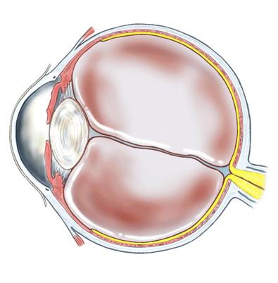 What is a cataract? The natural lens in your eye helps you to see clearly by focusing the light rays entering your eye (see figure 1). A cataract is when the natural lens becomes cloudy.