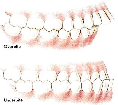 Malocclusion is the term used when the occlusion, or bite, is not ideal.