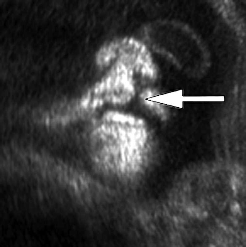 Unilateral incomplete cleft lip in fetus at 34 weeks' gestation.