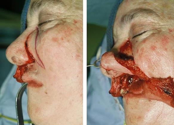 A lip-split approach was utilized for resection and to facilitate the reconstruction