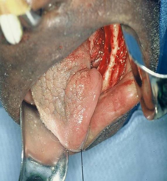 cancer resection resulted in an alveolar ridge, gingiva, and