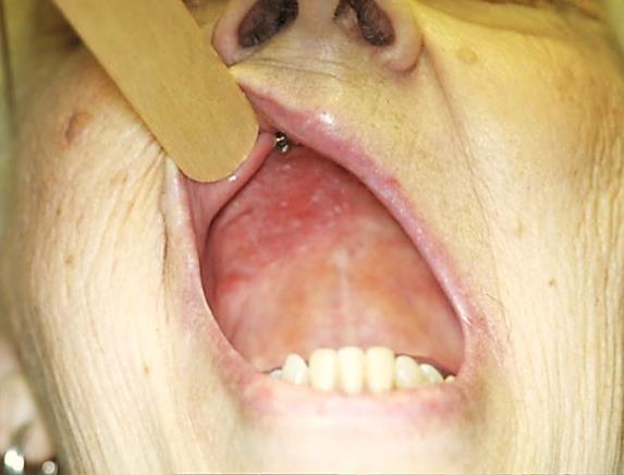 visible for a dental prosthesis.