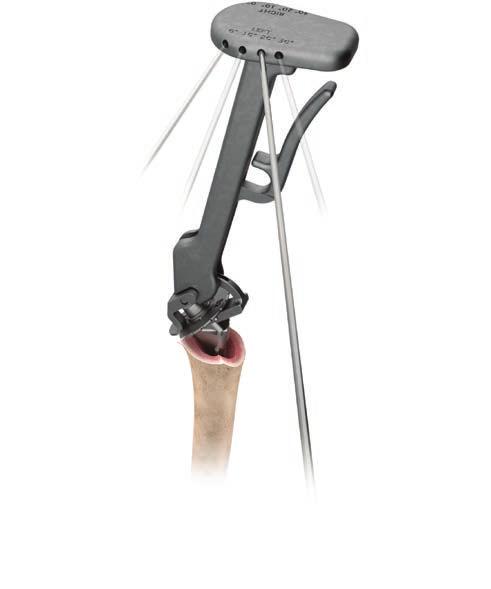 TRIAL IMPLANTATION AND TUBEROSITY REDUCTION: PRESS-FIT FIXATION Press-Fit Trial Assembly and Positioning Assemble the selected stem with the corresponding proximal body size 0 trial.