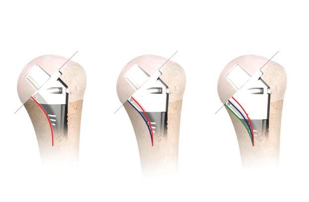 Press-Fit TRIAL IMPLANTATION AND TUBEROSITY REDUCTION: PRESS-FIT FIXATION Stem Height Adjustment If the trial stem and collar are too high, then remove the 0 mm proximal body and replace it with the
