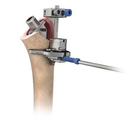 TRIAL IMPLANTATION AND TUBEROSITY REDUCTION: CEMENTED FIXATION Cemented Trial Assembly and Positioning: Using a Positioning Jig Assemble the chosen stem with the corresponding proximal