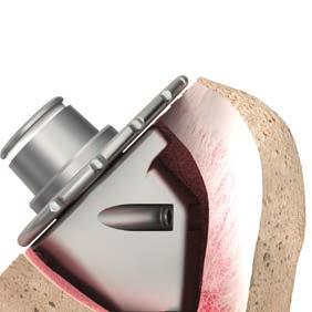 During range of motion testing, the trial implant should remain in the glenoid fossa and the head should not ride high in the glenoid.