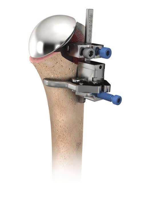 Cemented FINAL STEM AND PROXIMAL BODY ASSEMBLY AND IMPLANTATION CEMENTED FIXATION Digitally insert bone cement such as DePuy SMARTSET GHV or HV Bone Cement into the medullary canal.