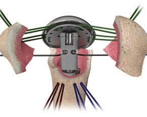 Press-Fit Fixation Trial Insertion with