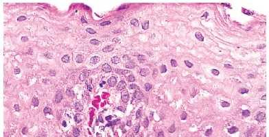GERD Histology in NERD on endoscopy Epithelial hyperplasia Basal