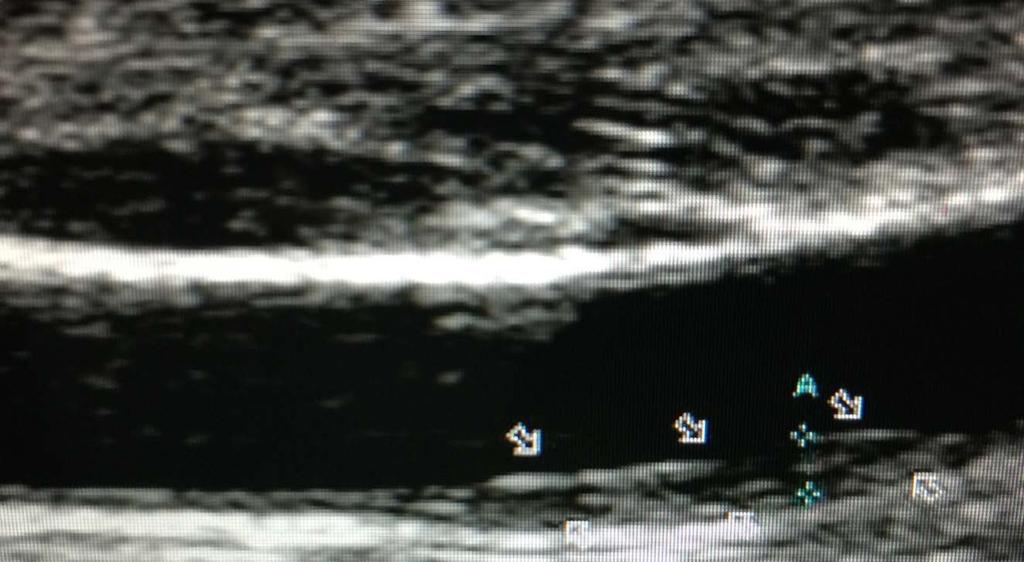 3:Colour Doppler showing arterial stenosis and