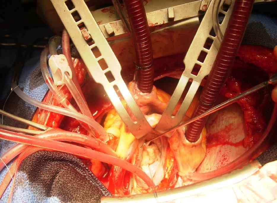 Pulmonary artery Aorta Superior vena cava RIGHT ATRIUM Pulmonary artery LEFT ATRIUM Pulmonary veins Pulmonary veins Semilunar valve Semilunar valve