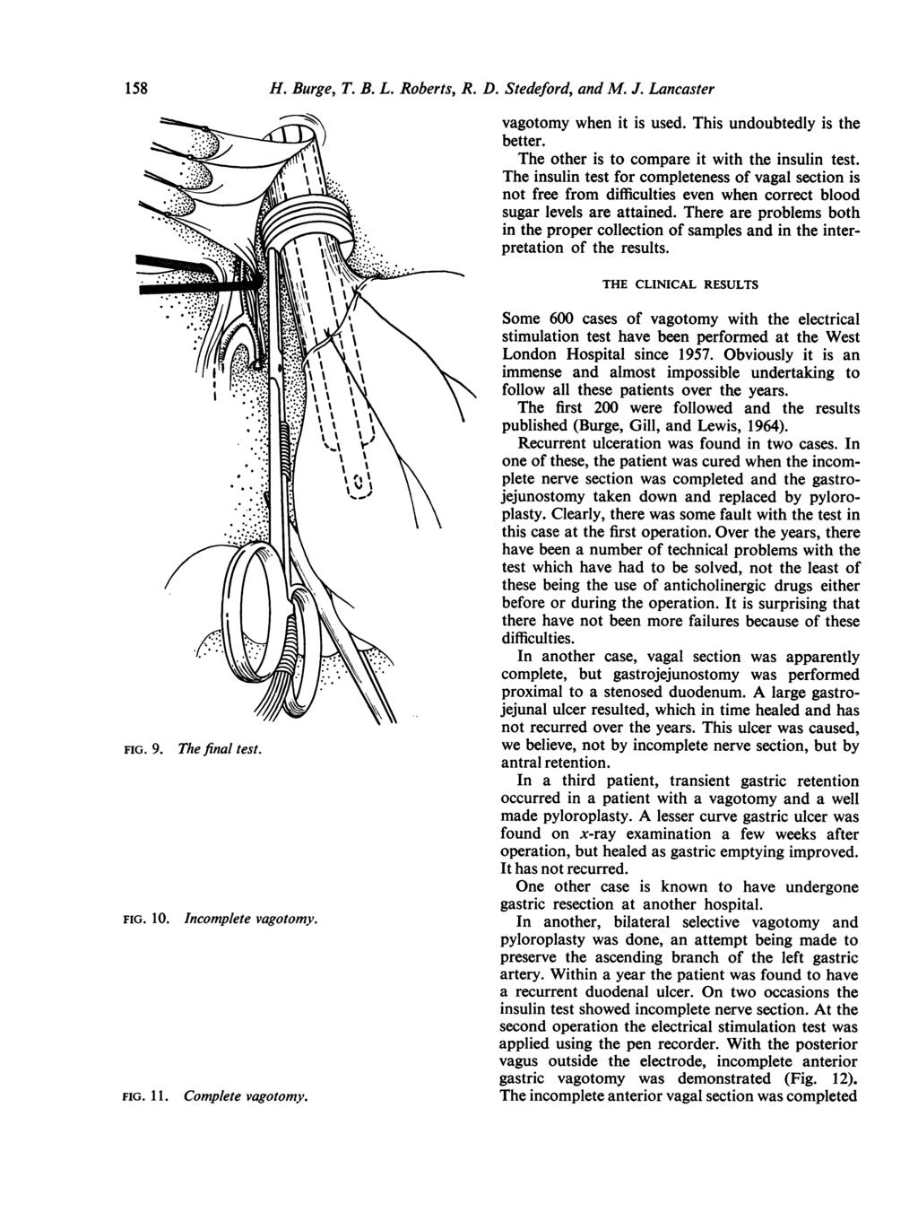 158 FIG. 9. FIG. 10. The final test. Incomplete vagotomy. FIG. 11. Complete vagotomy. H. Burge, T. B. L. Roberts, R. D. Stedeford, and M. J. Lancaster vagotomy when it is used.