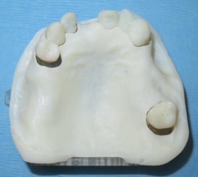 Two-year Evaluation of a Variable-Thread Tapered Implant in Extraction