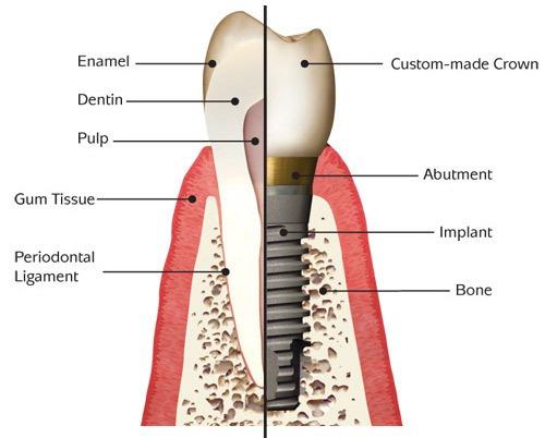 foundation for your new tooth or teeth to be attached.
