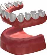 Implant solutions for denture wearers Implants can also be used to support full dentures.