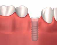 Getting your dental implant Because traditional methods of tooth replacement, such as crowns, bridges, partials, and dentures, have disadvantages in terms of appearance and function, dental implants