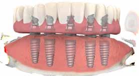 What is Teeth on Implants?