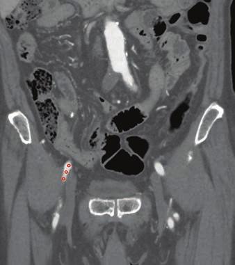 We retrospectively evaluated consecutive patients who had severe leg pain due to arterial occlusion in the iliac or femoropopliteal arteries and who underwent CT and conventional angiography for an