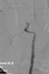 The lesion was predilated with a 2 20 mm Invatec balloon and covered with a 3 18 mm Apollo stent for the V4 and a 3 15 mm Apollo stent for the V3 ((d), (e)).