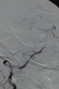 severe stenosis (>70%) verified by computed tomography (CT), magnetic resonance (MR), or conventional angiography; (3) symptoms refractory to double antiplatelets (aspirin 300 mg/day and clopidogrel