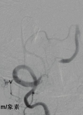The lesion was predilated with a 2 20 mm Invatec balloon (d) and covered with a 3 19 mm Invatec balloon-expandable stent (e). A 24-month follow-up CTA showed mild in-stent stenosis (f).