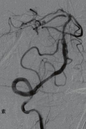 For the 3 patientswithout follow-up angiography, the lumen patency was confirmed with CT angiography in 2 patients and with transcranial Doppler in 1 patient. 4.