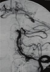 A 71-year-old man (case 7) with the left ICVA