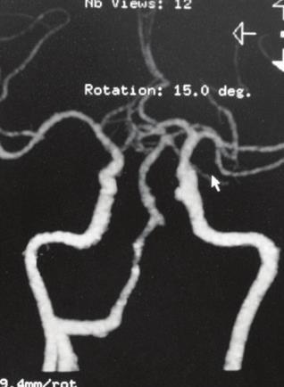 A 37-year-old man (case 8) with the left ICVA