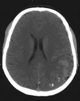 Romanian Neurosurgery (2014) XXI 2: 206-211 207 originating from distal M2 segment of left middle cerebral artery.