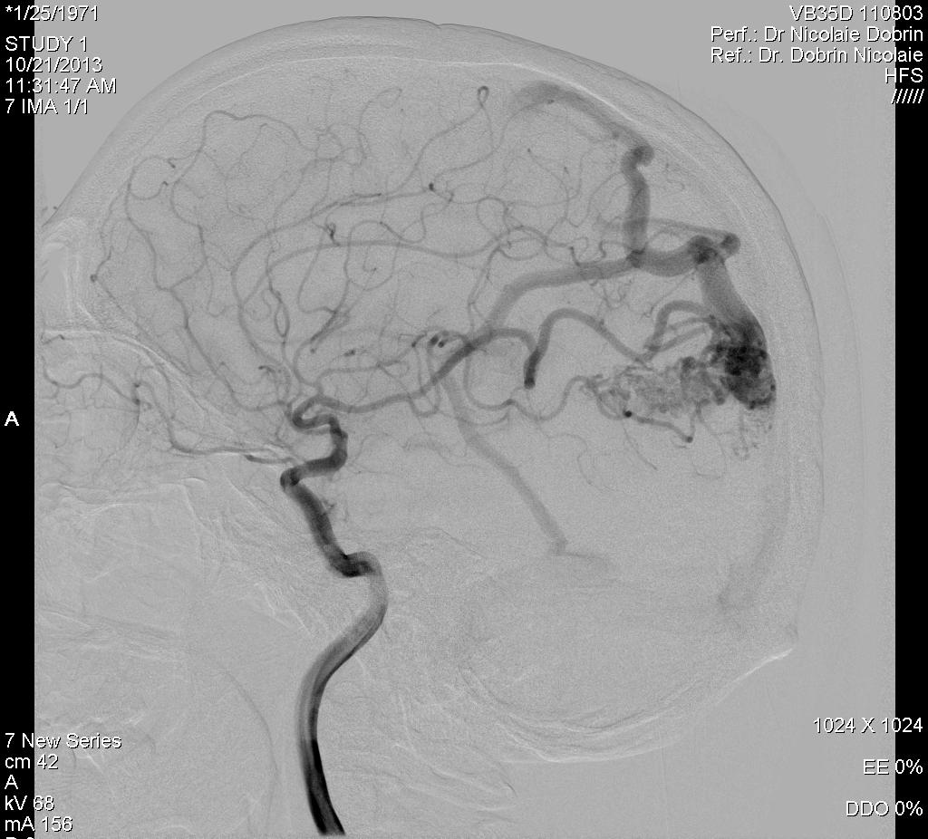 T2 sequence suggesting for an arteriovenouse malformation Digital subtraction angiography (DSA) of intracranial vessels
