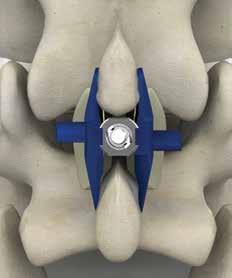 Maintain direct visualization of the cut section at all times and secure for removal from the surgical site.