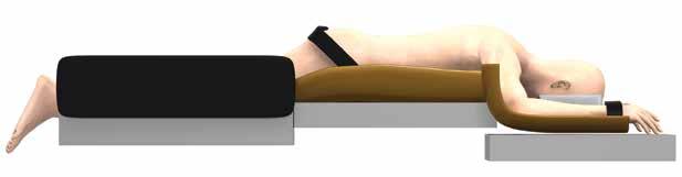 UniVise Spinous Process Fixation Plate Technique Step 1: Patient Positioning Place the patient on a radiolucent table in the prone and optimally-flexed position using a Wilson-like frame.