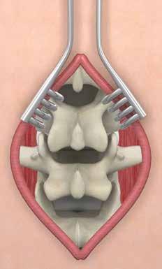 Step 4: Spinous Process Distraction Gently distract the spinous processes as required to allow placement of the Implant Trials and implant.