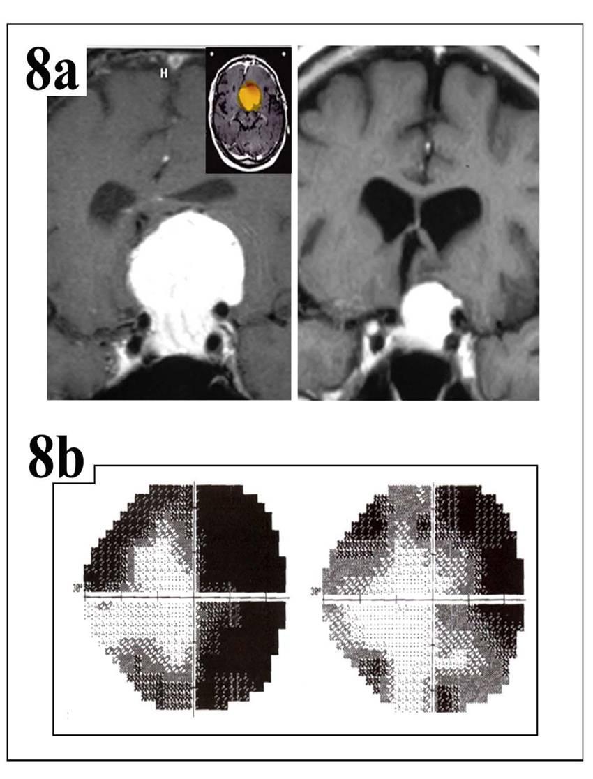 ONSM Patient 29 with planum/bilateral orbital apex tumor with