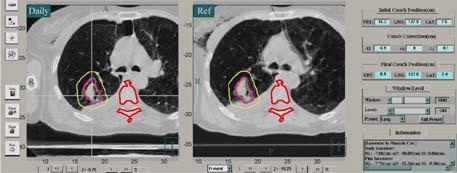 7.5mm Superior, Lung Window Conclusions Near-simultaneous CT image-guided guided verification technique can be used as a new platform technology for extra-cranial applications of stereotactic