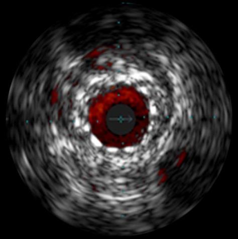 SCAI Expert Consensus Statement on IVUS in PCI Guidance: