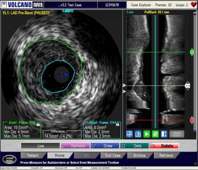 SCAI Expert Consensus Statement on IVUS in PCI Guidance: Definitely Beneficial For determining the size of the vessel undergoing stent implantation Lotfi A, et al.
