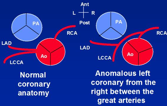 Coronary Artery Abnormalities; Possible