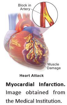 Myocardial infarction Myocardial infarction is caused by coronary artery occlusion provoking irreversible myocardial ischemia, loss of cardiomyocytes and formation of a non-contractile fibrous scar.