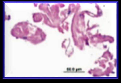 collagenous tissue valve tissue thrombus