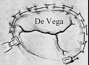 De Vega Suture Annuloplasty Rev Esp Cardiol. 1972 Nov-Dec;25(6):555-6.