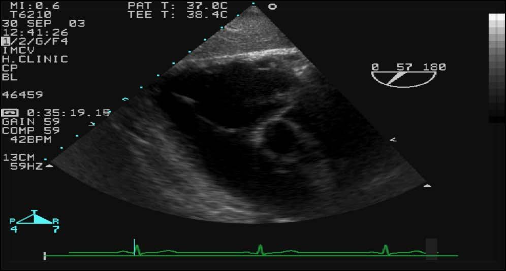 Tricuspid tumors STS and