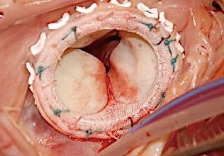 Tricuspid replacement: bioprosthetic or mechanical valve?