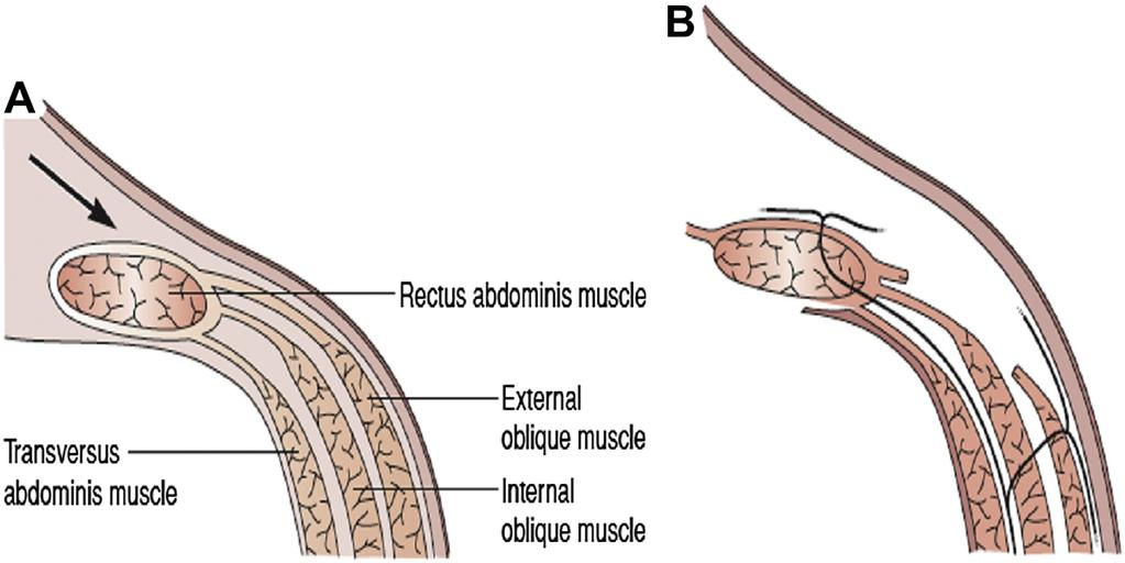 18 BIKHCHANDANI & FITZGIBBONS JR abdominal wall, which allows medialization of the rectus muscles to achieve approximation of the abdominal musculature in the midline.