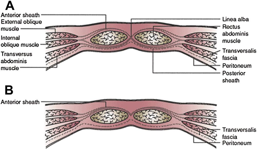 GIANT VENTRAL HERNIA 5 Fig. 3. Composition of rectus sheath above (A) and below (B) the umbilicus.
